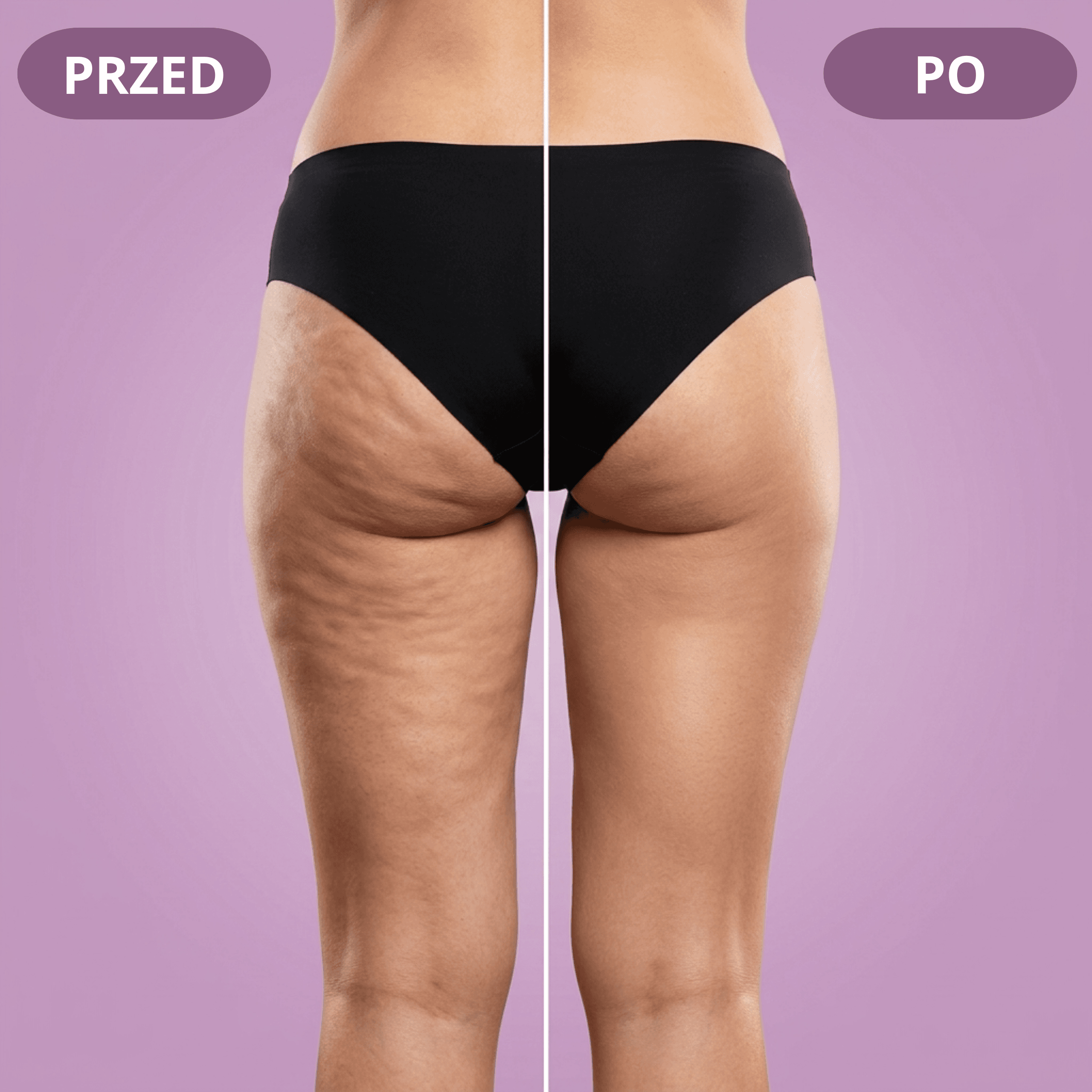 Masażer Próżniowy Antycellulitowy CELLURIA